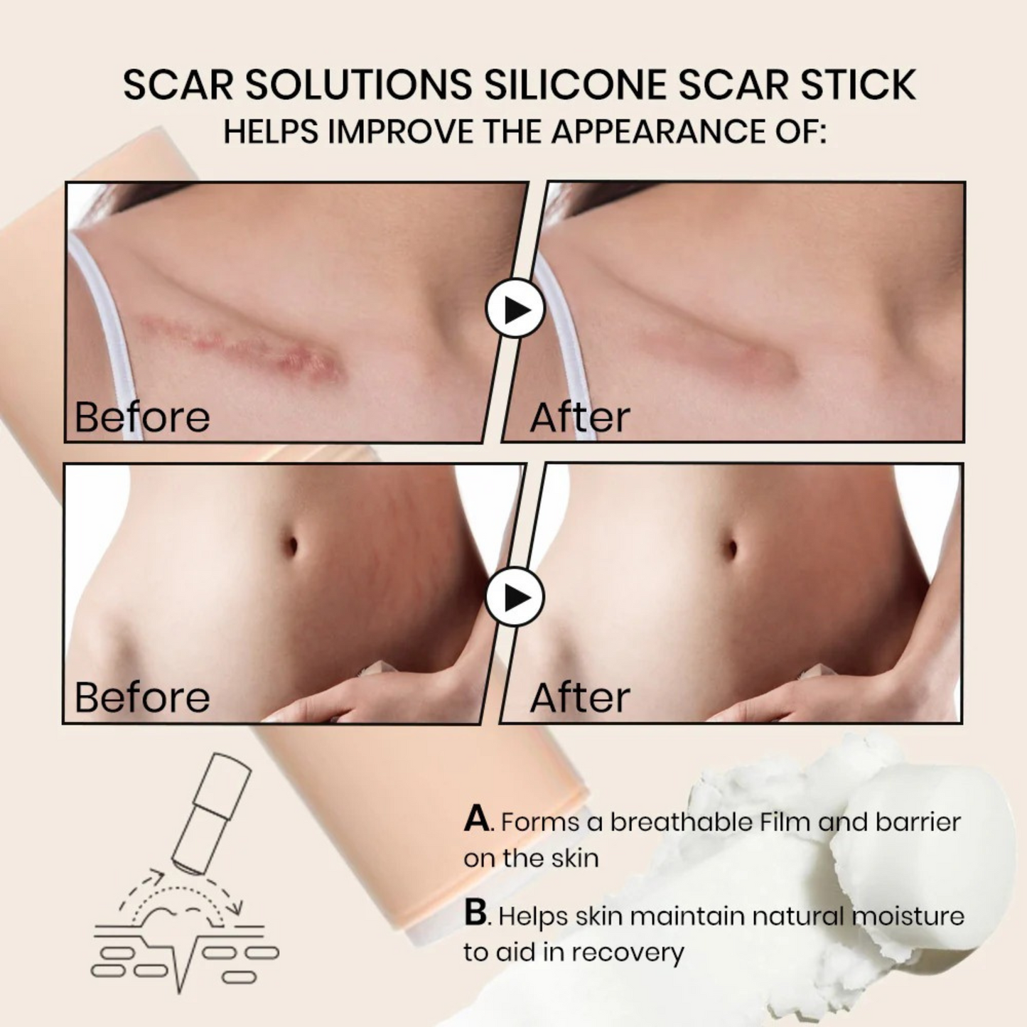 Silicone Scar stick